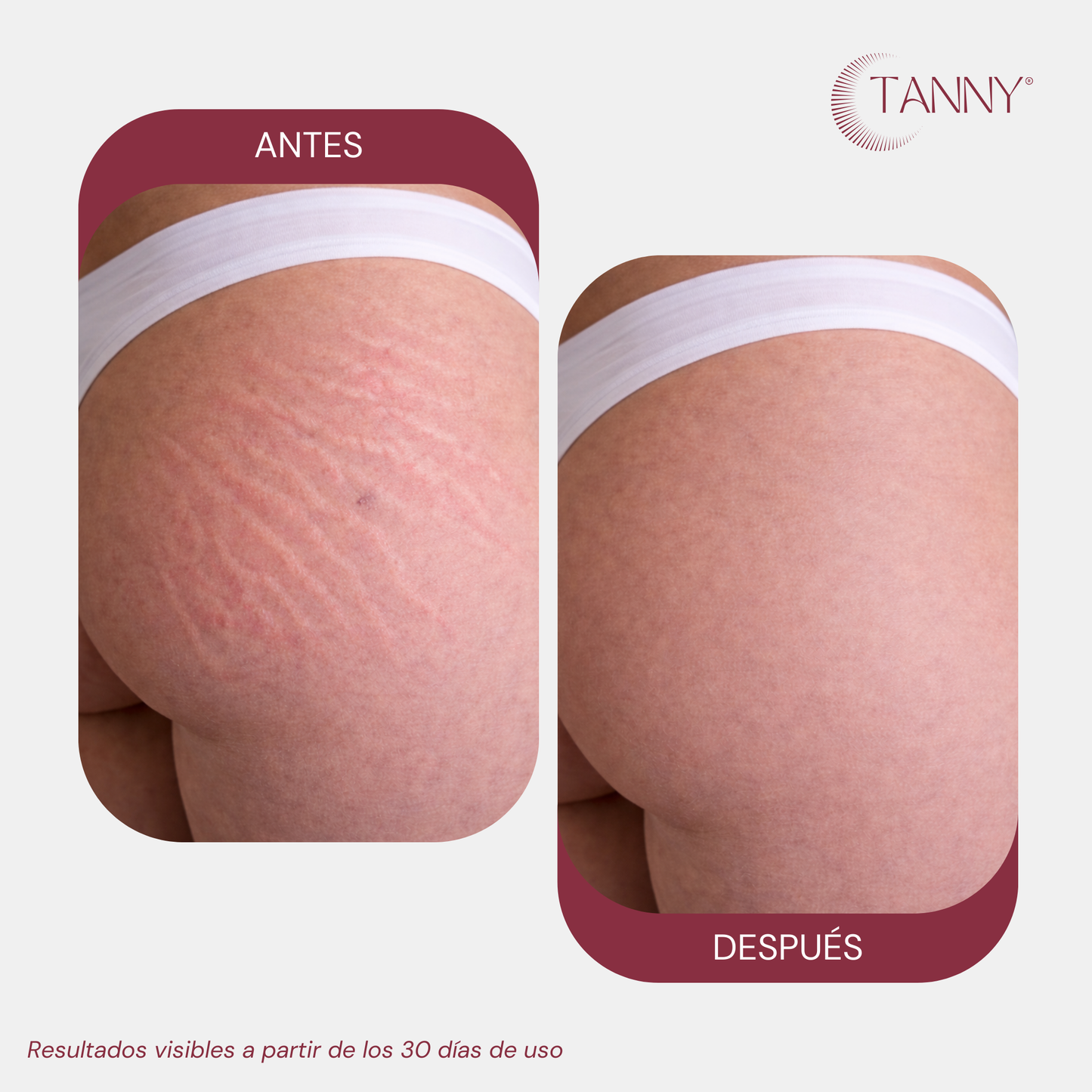 Tratamiento Intensivo Para Estrías y Arañitas Corporal