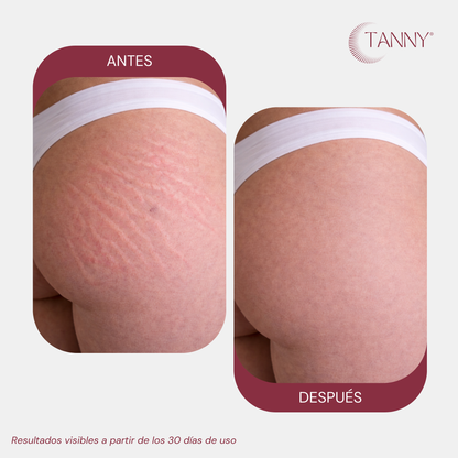 Tratamiento Intensivo Para Estrías y Arañitas Corporal