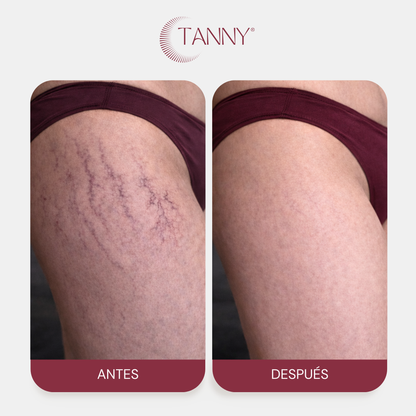 Tratamiento Intensivo Para Estrías y Arañitas Corporal
